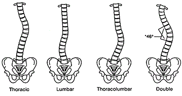 scoliosis spine curvature abnormal lateral include curvatures flowvella journey human systems