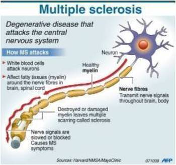 Multiple Sclerosis - Systems of the Human Body